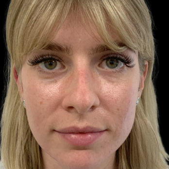 ultrasonic-rhinoplasty-before